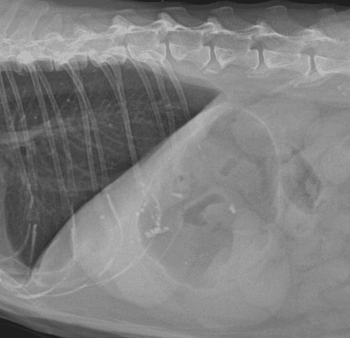담석 진단 예시 이미지