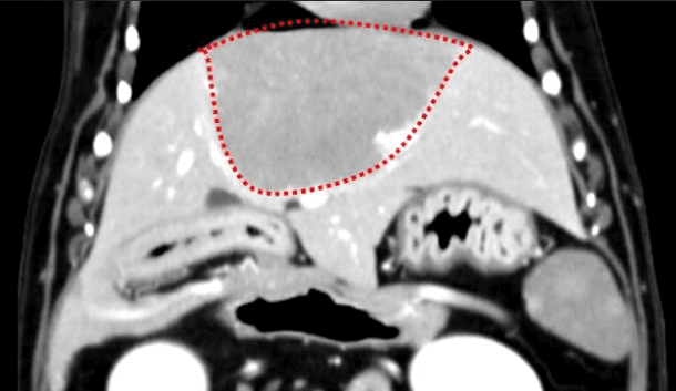 간종양 진단 예시 이미지
