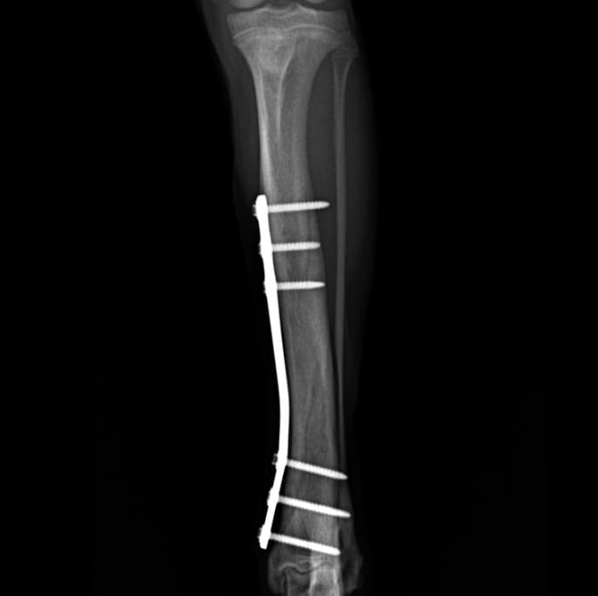 복합 골절 치료 예시 이미지