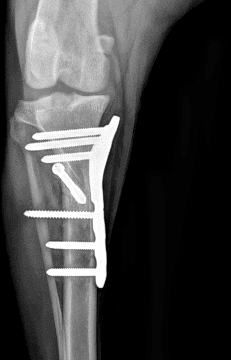 십자인대교정 CBLO 수술 예시 이미지 2