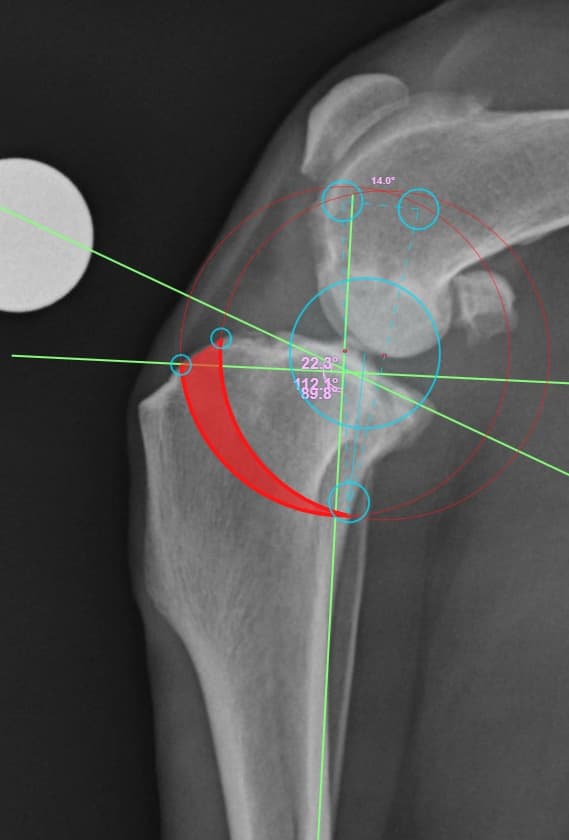 십자인대교정 Double TPLO 수술 예시 이미지